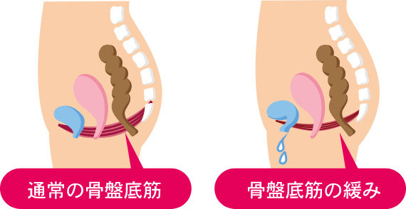 原因は骨盤底筋の”ゆるみ”かも…